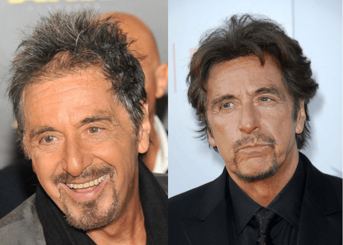 Celebrities Going Through Hair Loss & Their Treatments