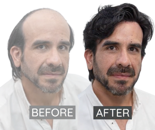 Video:  Why Be Bald? - Leo's Incredible Hair System Transformation in Sydney