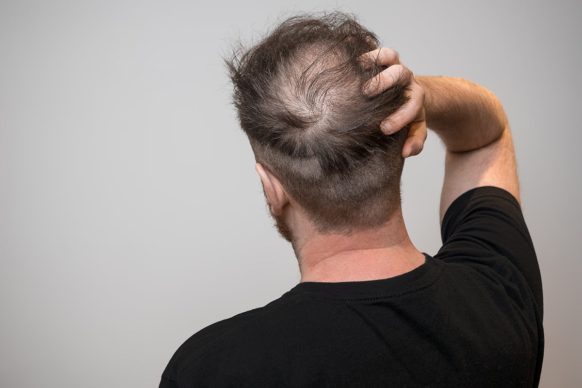Thinning Hairline? How Toppers Can Restore Your Confidence