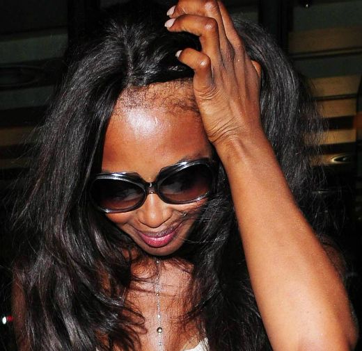 I Have Female Hair Loss: Now What?