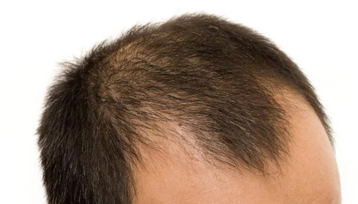 Male Baldness May Not Mean High Fertility
