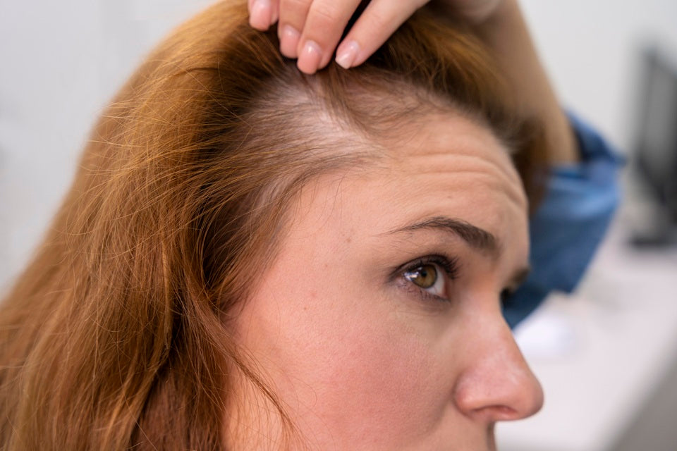 Alopecia Areata Story - What it Feels Like to Lose Your Hair!