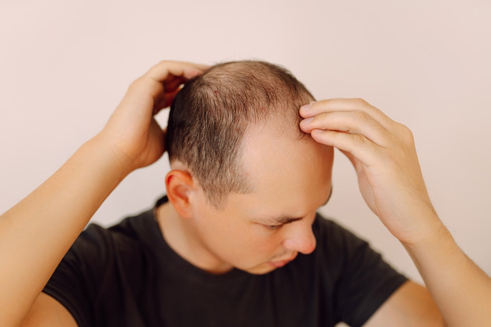 Alopecia in Men