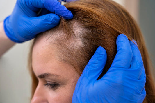 Alopecia Areata: Hair Loss and the Grieving Process