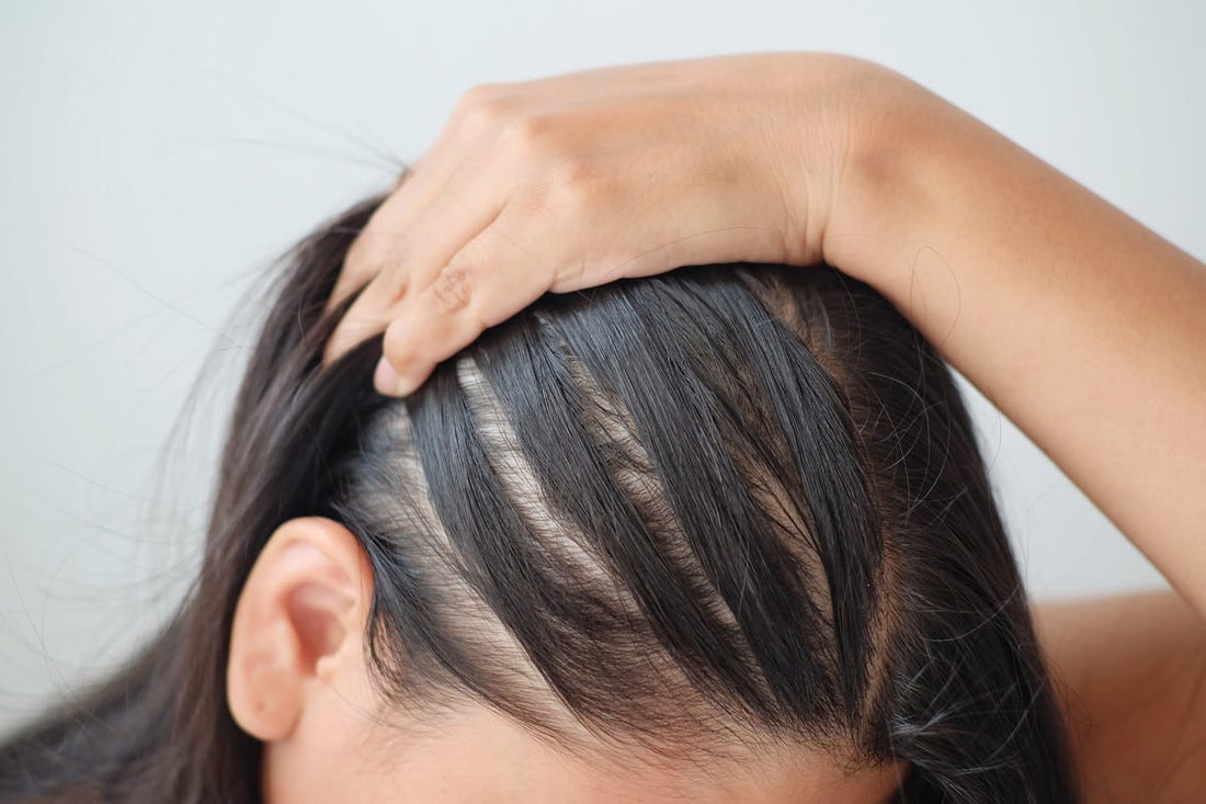 Four Common Causes of Female Hair Loss