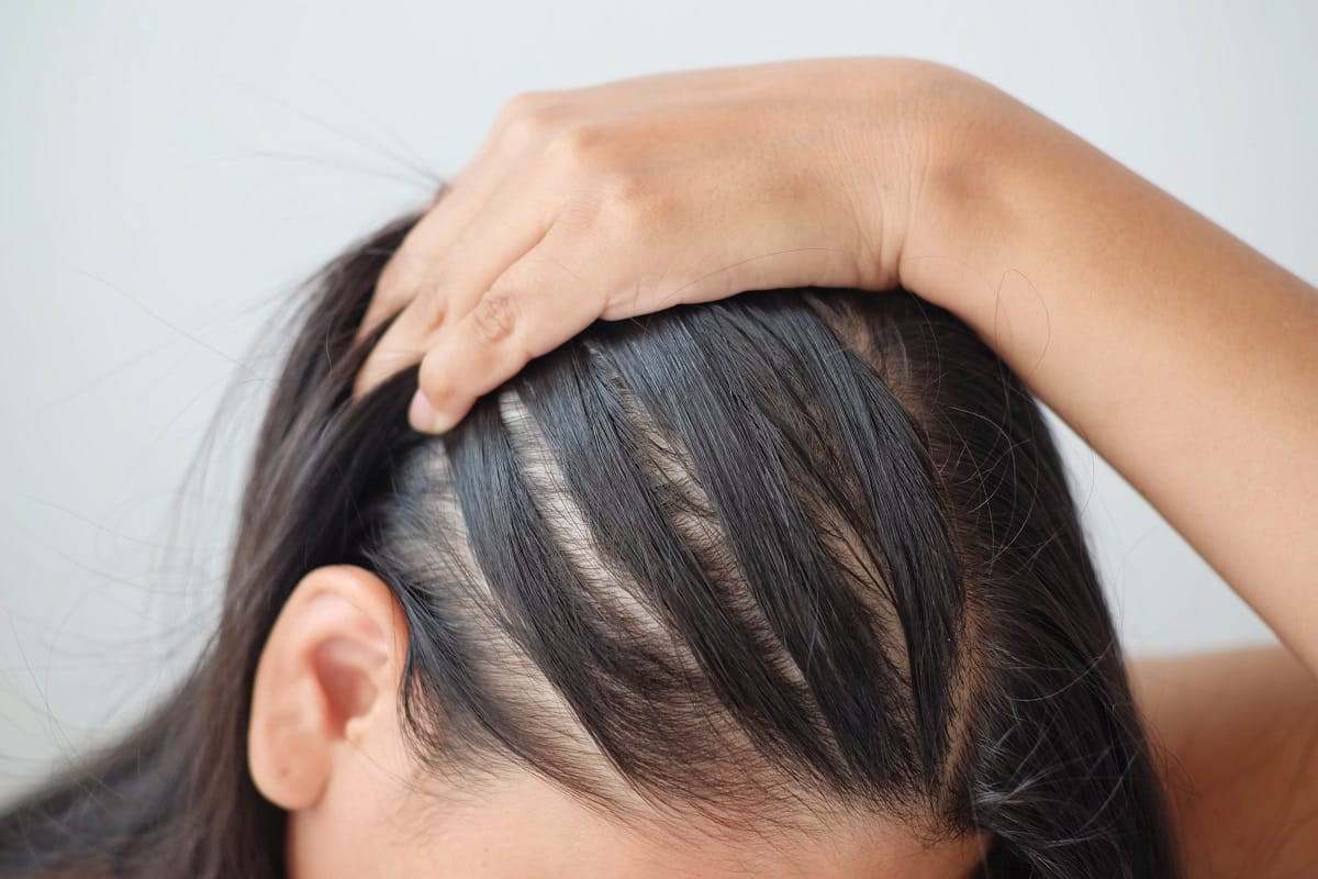 Four Common Causes of Female Hair Loss