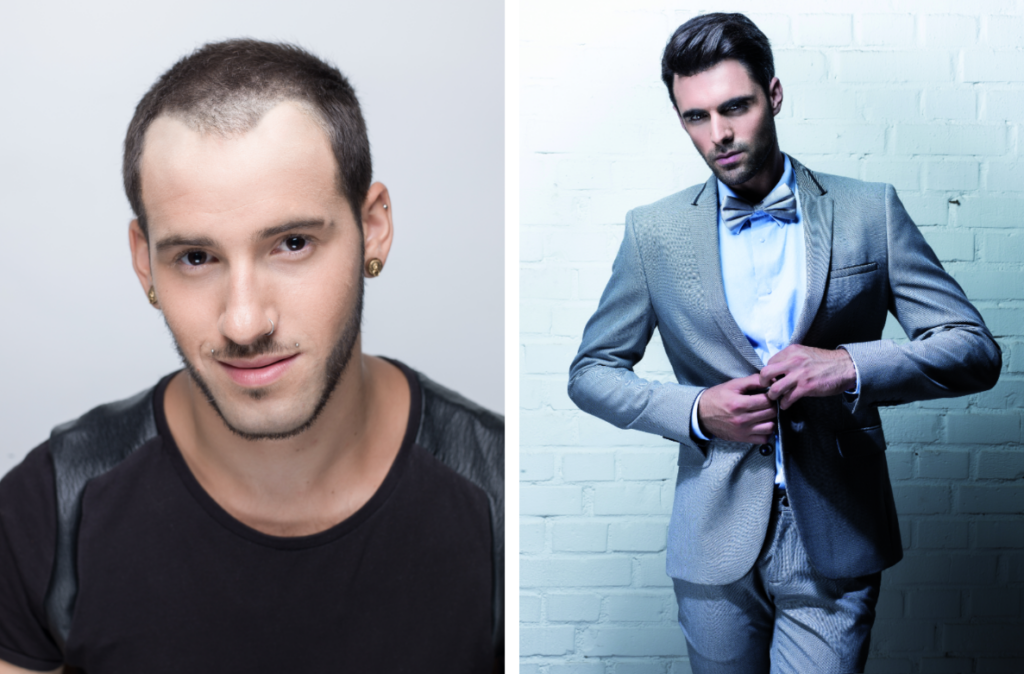 Your Man Bun could be the Hair Loss Culprit!