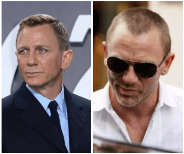 Hair Loss