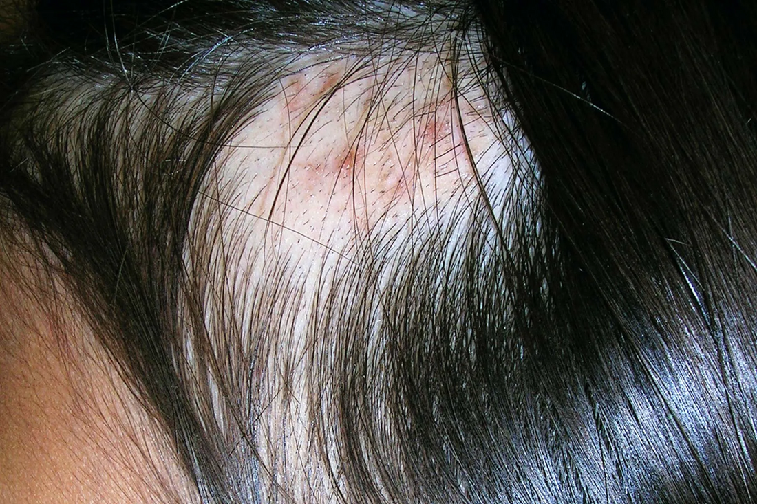 Trichotillomania is Now Being Linked to Food Allergies