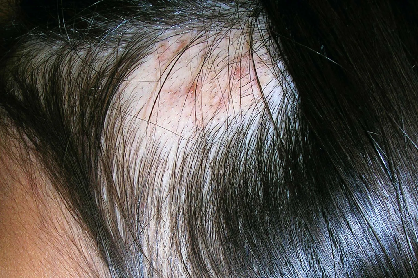 Trichotillomania is Now Being Linked to Food Allergies