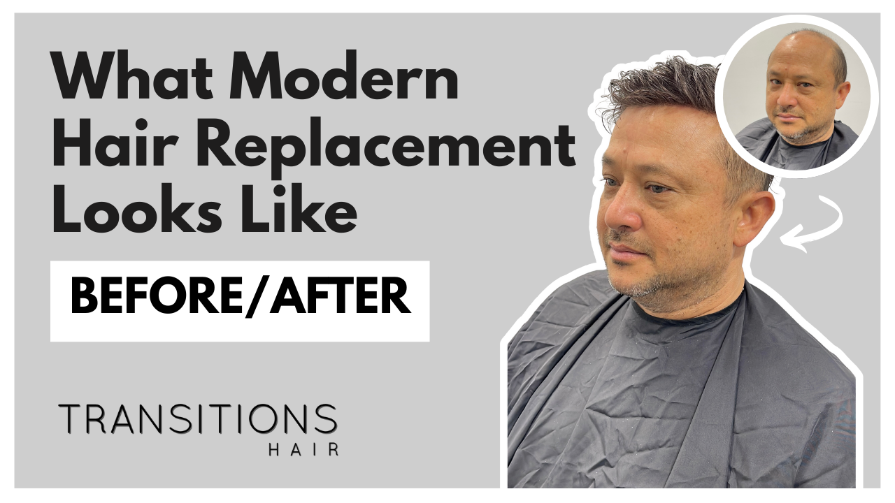 How Men Fix Hair Loss Today