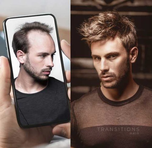 Which Hair Replacement option is Right for me?