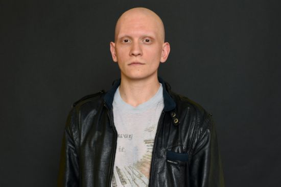“Gotham” Star and Alopecia Sufferer Anthony Carrigan Shares His Hair Loss Story