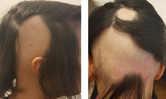 Scientific Breakthrough for Alopecia:  Columbia University Researcher Dr. Angela Christiano