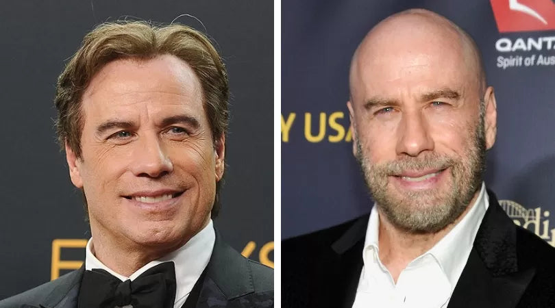 Famous Faces and Their Discreet Hair Loss Solutions: Men Who Rocked Toupees