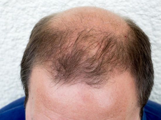Cancer Drug Could Cure Baldness