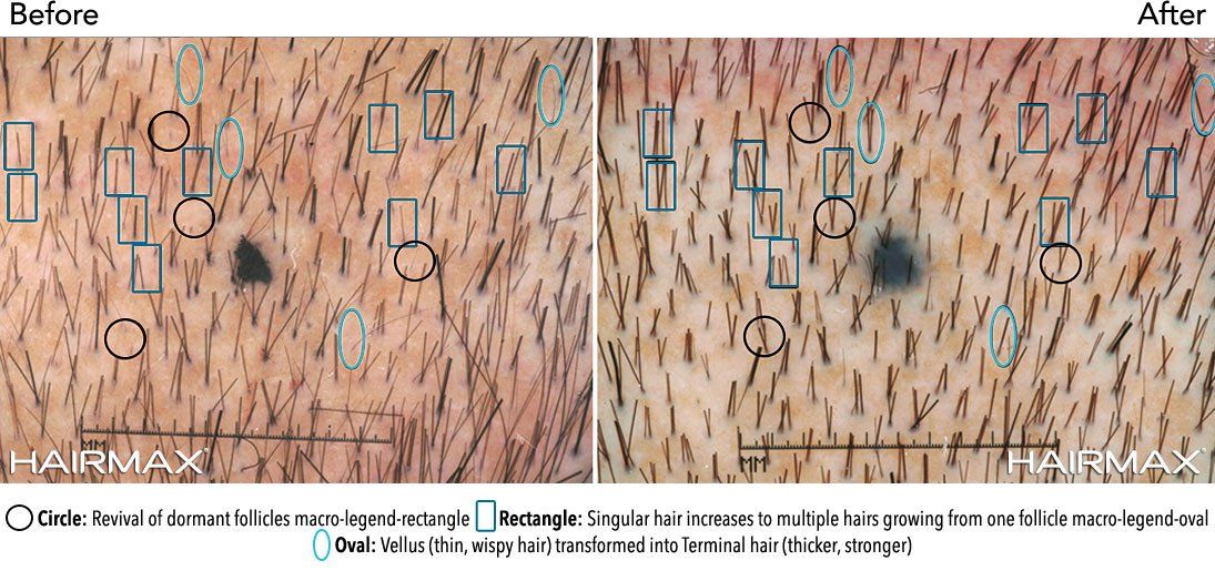 multiple hairs in one follicle