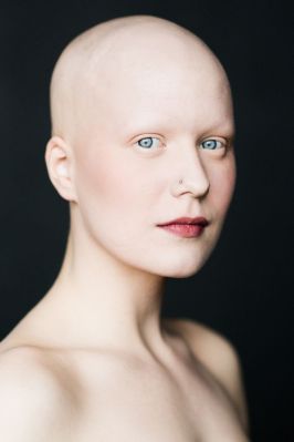 Beautiful Girl with Alopecia
