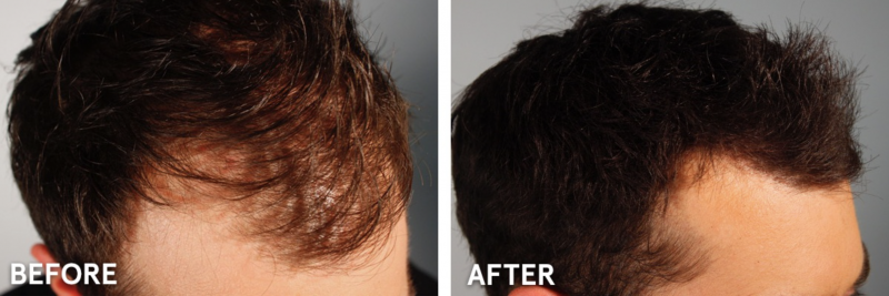 biothik before and after for thinning hair