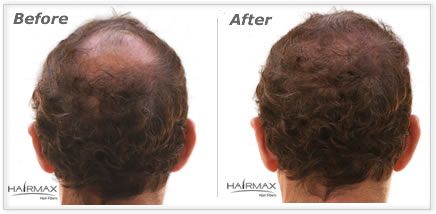HairMax Nanogen Toppik Keratin Hair Fibers before and after photos