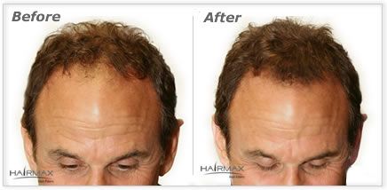 HairMax Nanogen Toppik Keratin hair fibers before and after photos