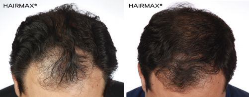 male before and after with hairmax